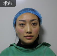 去眼袋手术