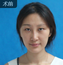 去眼袋手术