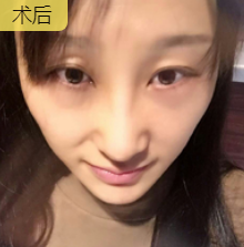 去眼袋手术