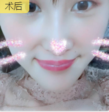 去眼袋手术