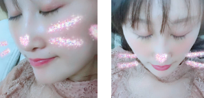 去眼袋手术