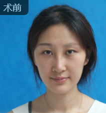 去眼袋手术