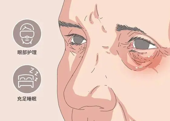 去眼袋手术