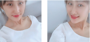 去眼袋手术