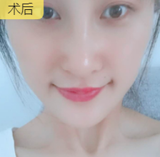 去眼袋手术