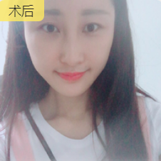 去眼袋手术