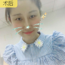 去眼袋手术