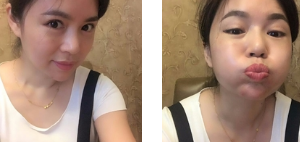 去眼袋手术