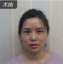 去眼袋手术