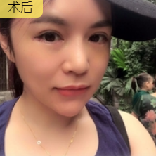 去眼袋手术
