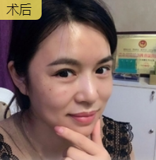 去眼袋手术