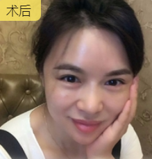 去眼袋手术