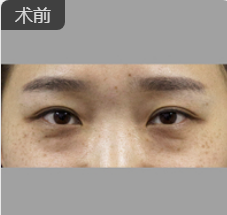 去眼袋手术