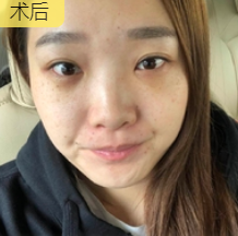 去眼袋手术
