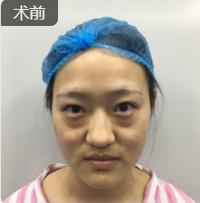 去眼袋手术