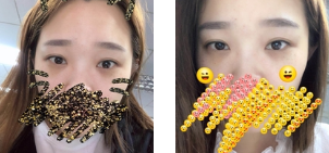 去眼袋手术