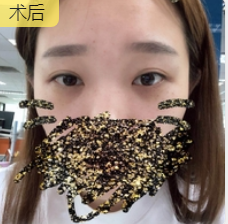 去眼袋手术