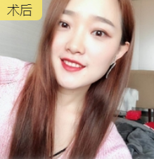 去眼袋手术