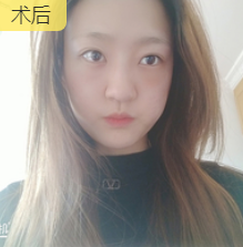 去眼袋手术
