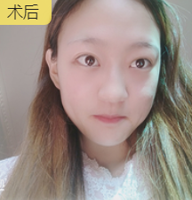 去眼袋手术