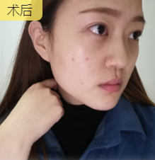 去眼袋手术