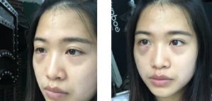 在超雅祛掉眼袋忌口几天?不能吃什么?257 在超雅祛掉眼袋忌口几天?不能吃什么?257