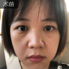 去眼袋手术