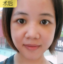 去眼袋手术