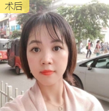 去眼袋手术