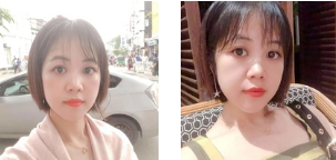 去眼袋手术