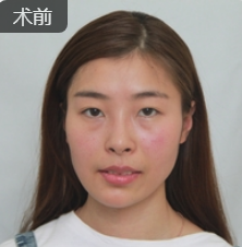 去眼袋手术