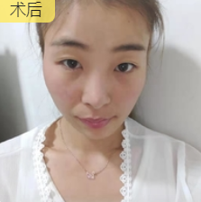 去眼袋手术