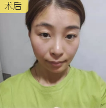 去眼袋手术