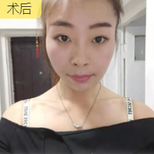 去眼袋手术