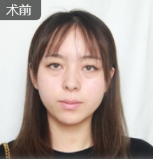去眼袋手术