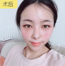 去眼袋手术