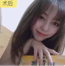 去眼袋手术