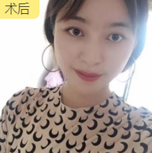 去眼袋手术