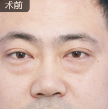 去眼袋手术