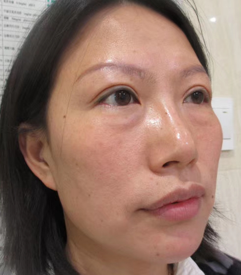 去眼袋手术