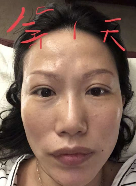 去眼袋手术