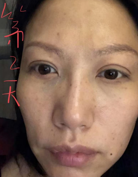 去眼袋手术