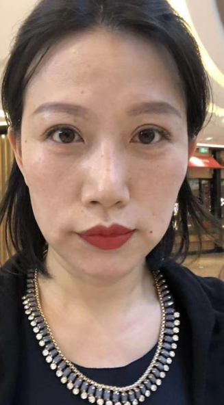去眼袋手术