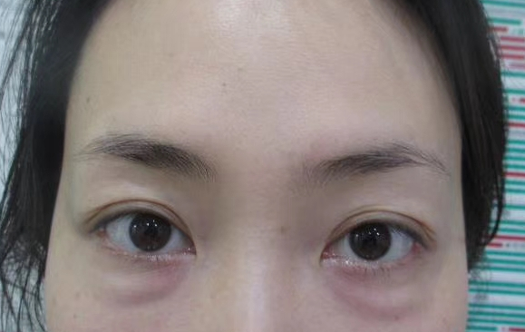 去眼袋手术