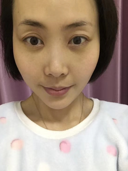 去眼袋手术
