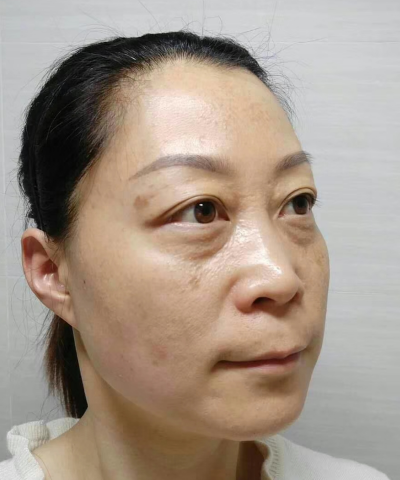 不开刀式治疗眼袋也分类?超雅怎样?747 不开刀式治疗眼袋也分类?超雅怎样?747