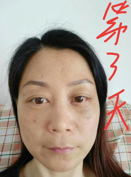 不开刀式治疗眼袋也分类?超雅怎样?747 不开刀式治疗眼袋也分类?超雅怎样?747