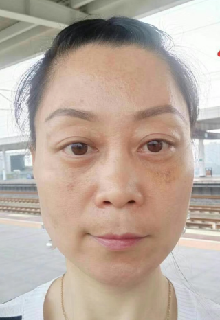 不开刀式治疗眼袋也分类?超雅怎样?747 不开刀式治疗眼袋也分类?超雅怎样?747