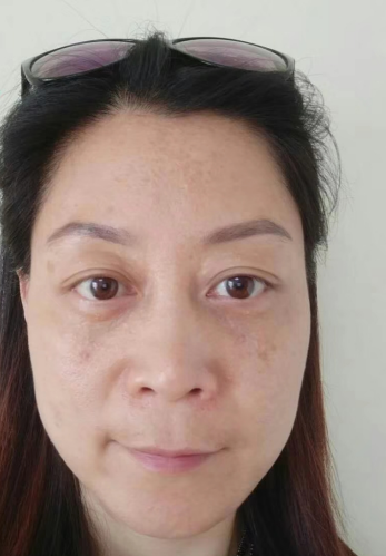 不开刀式治疗眼袋也分类?超雅怎样?747 不开刀式治疗眼袋也分类?超雅怎样?747