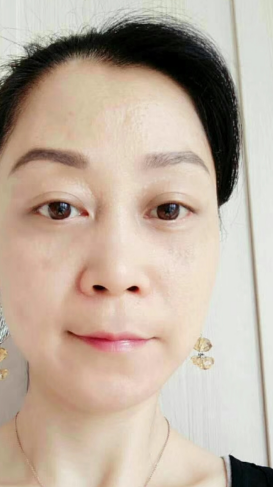 不开刀式治疗眼袋也分类?超雅怎样?747 不开刀式治疗眼袋也分类?超雅怎样?747